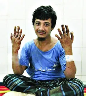 যে কষ্টে হাসপাতাল ছেড়েছেন বৃক্ষমানব